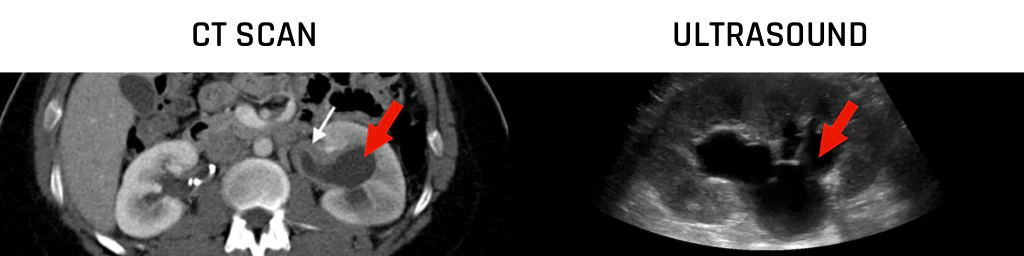 CT scan vs Ultrasound in Kidney Stone Imaging
