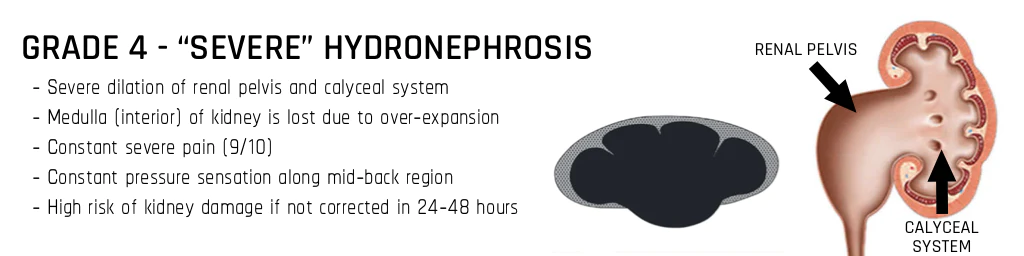 Grade 4-"Severe Hydronephrosis" characteristics