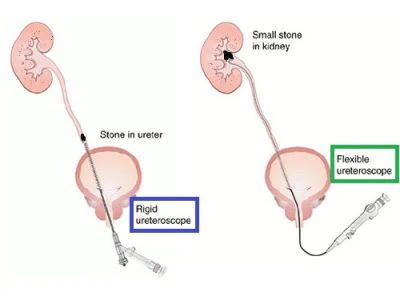Illustration comparing Rigid and Flexible Ureteroscopy