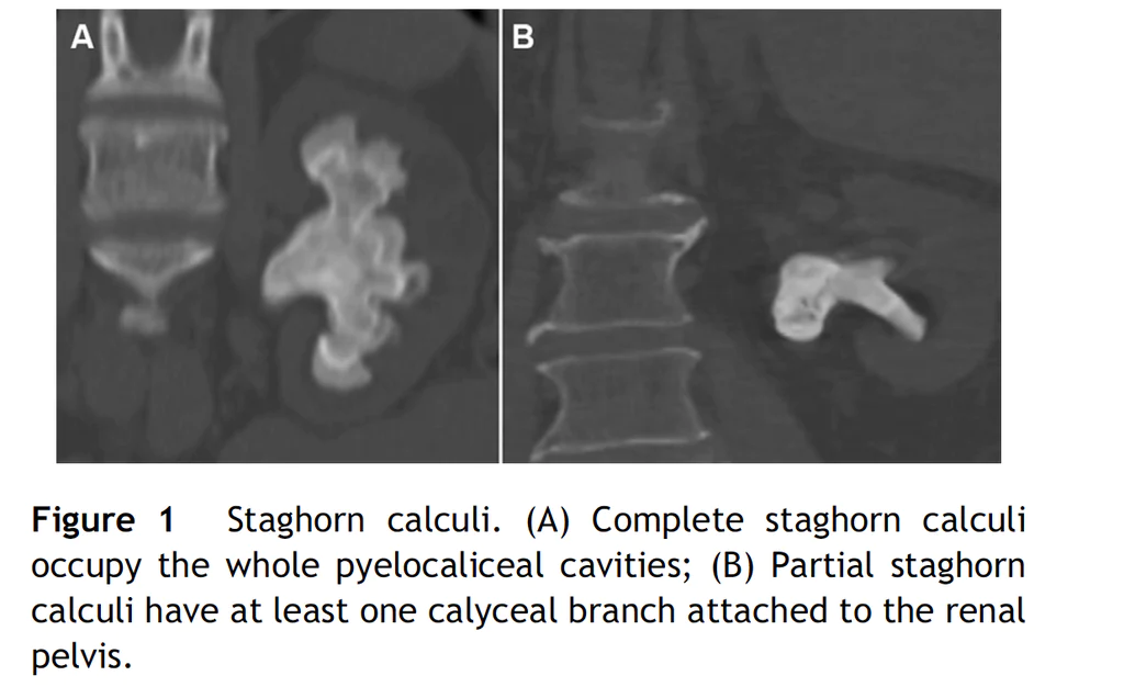 Photo of a Staghorn calculi