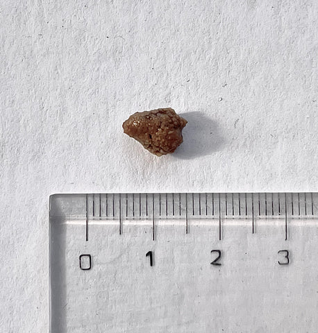 Picture of a whole kidney stone