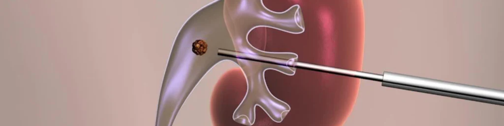 Illustration showing how a kidney stone is accessed