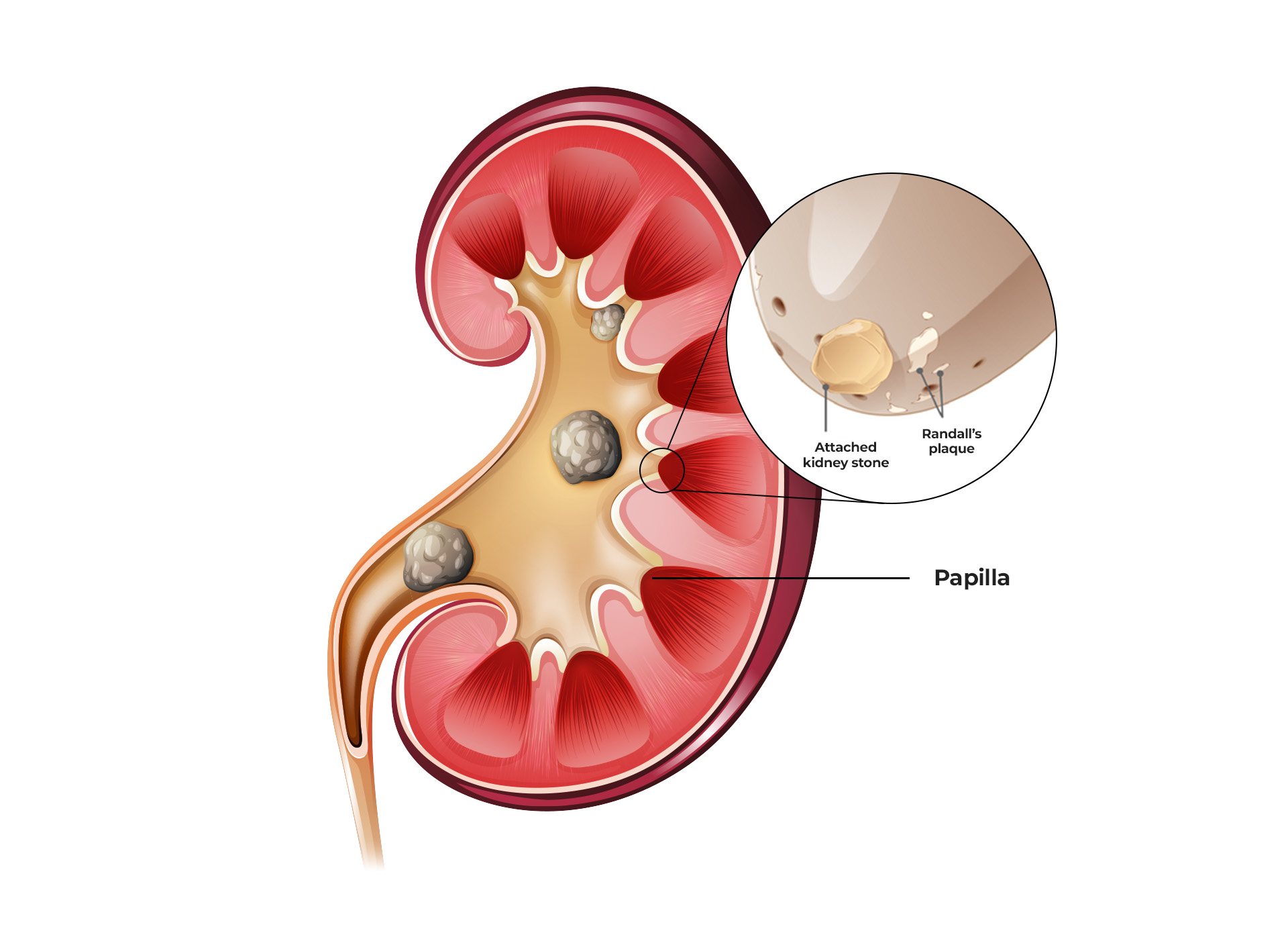 An illustration on how kidney stones form on Randall's Plaque.