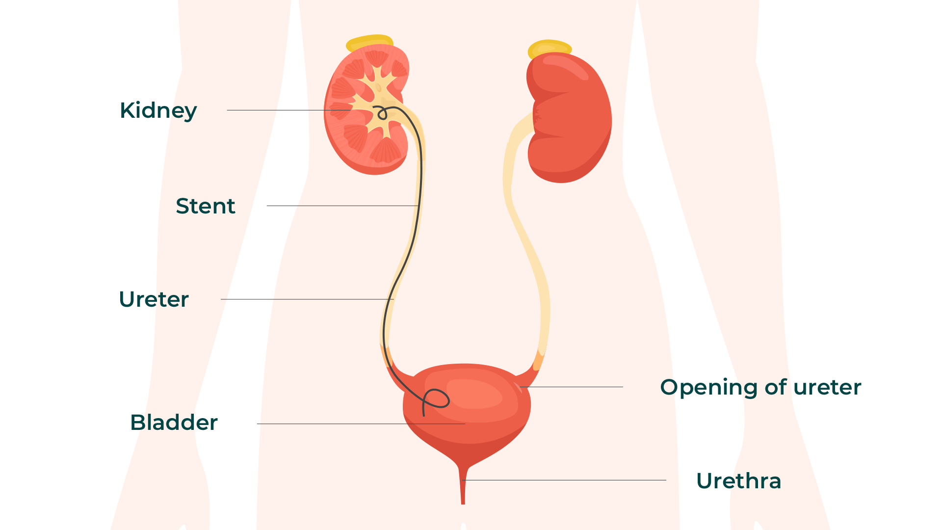 Urinary stent illustration