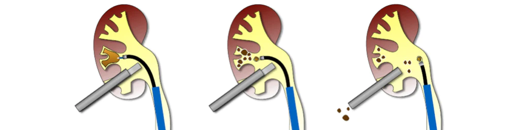 Illustration for an Endoscopic Combined Intrarenal Surgery