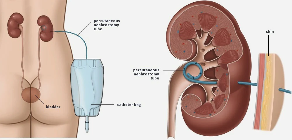 Illustration showing post-operative renal drainage