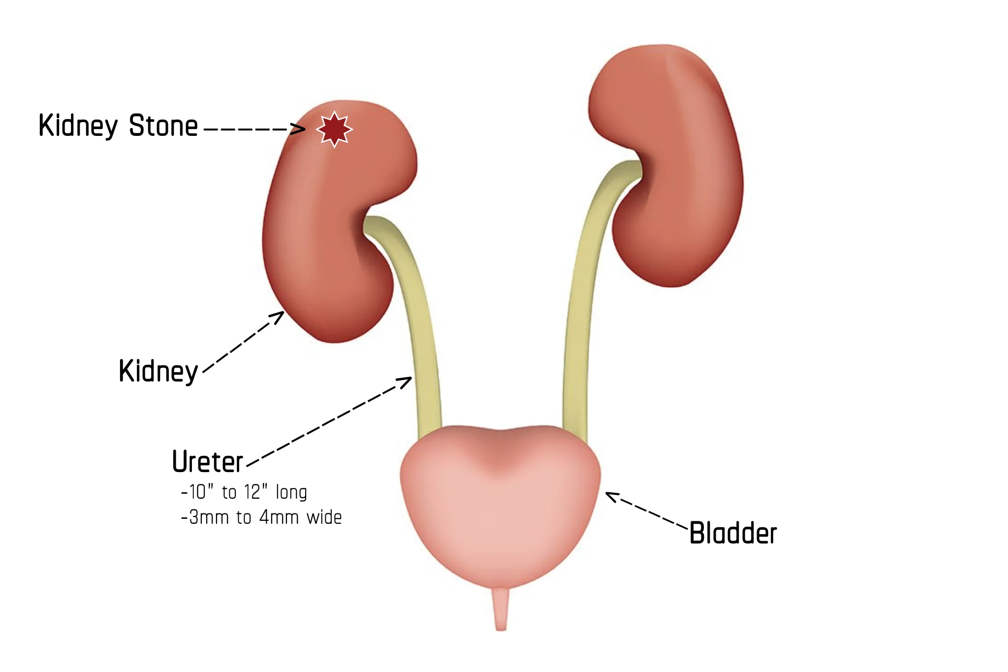 Illustration showing Stage 1 of Passing a Kidney Stone