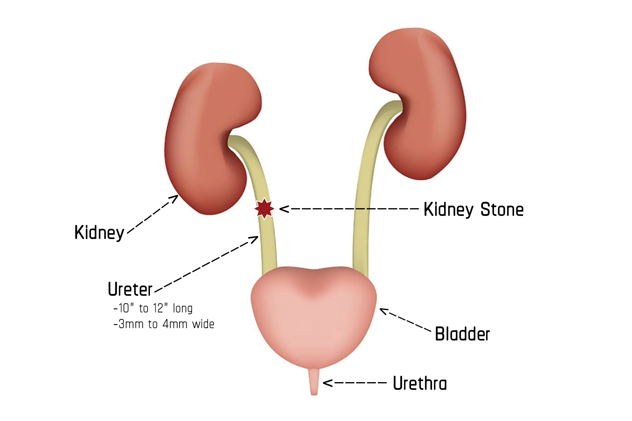 Illustration showing Stage 2 of Passing a Kidney Stone