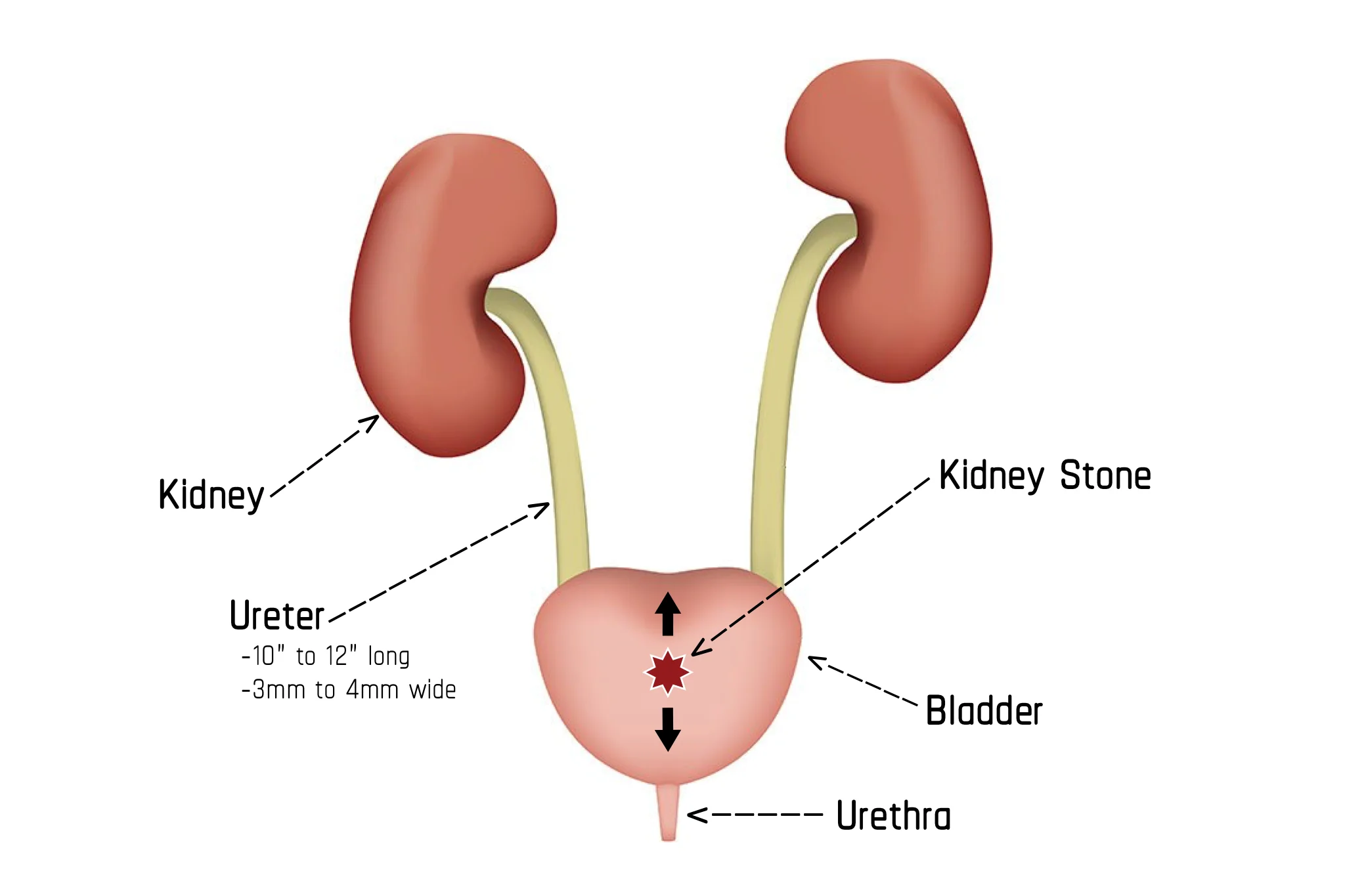 Illustration showing Stage 3 of Passing a Kidney Stone