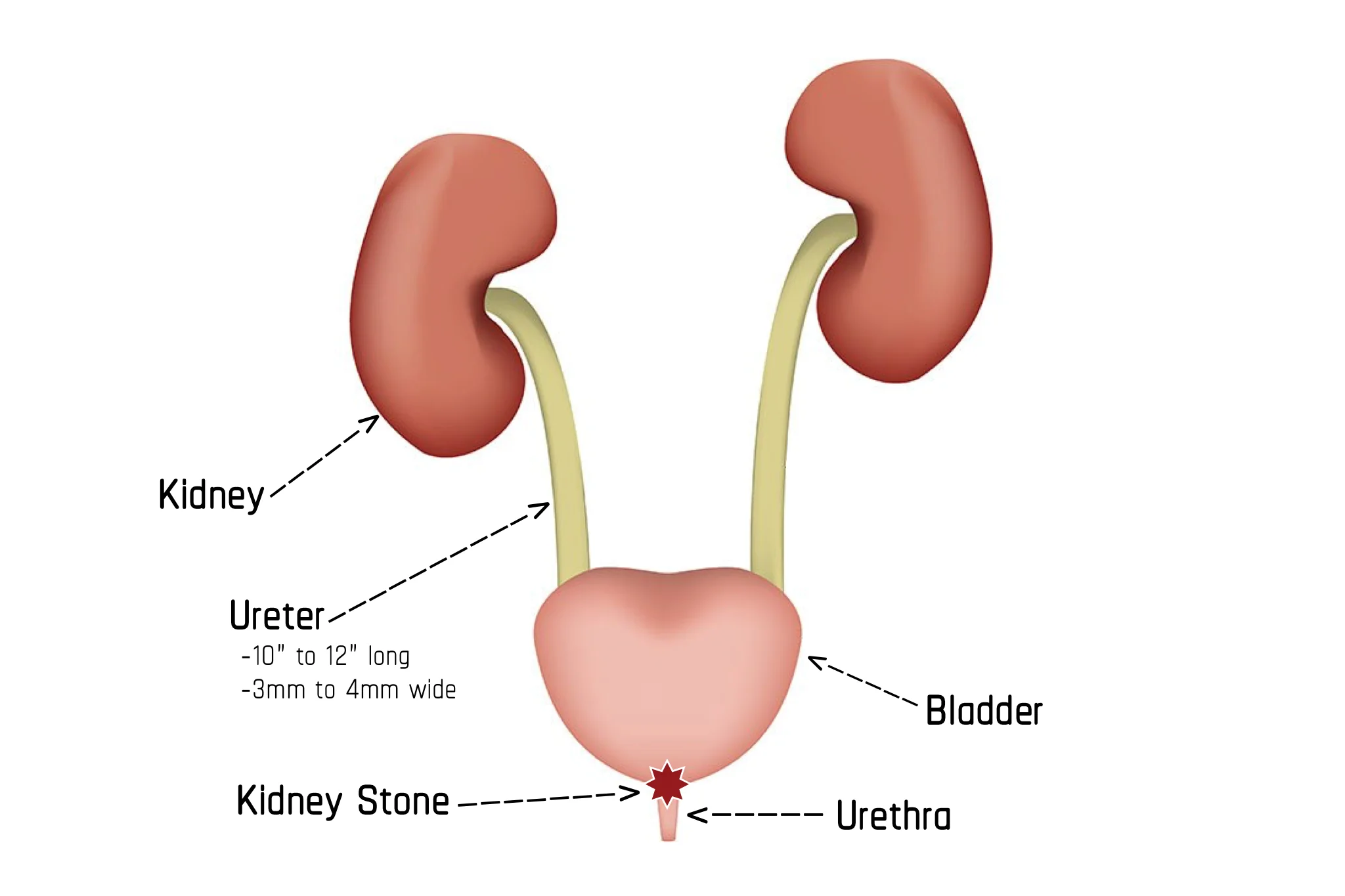 Illustration showing Stage 4 of Passing a Kidney Stone