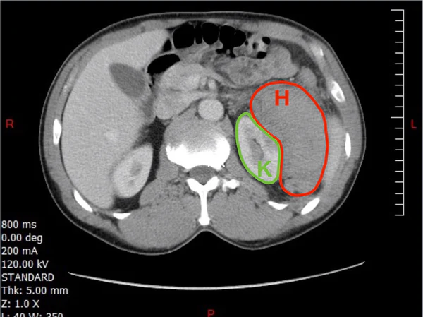 Photo of a Renal Subcapsular Hematoma CT Axial Annotated