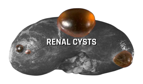 Illustration of the Renal Cyst