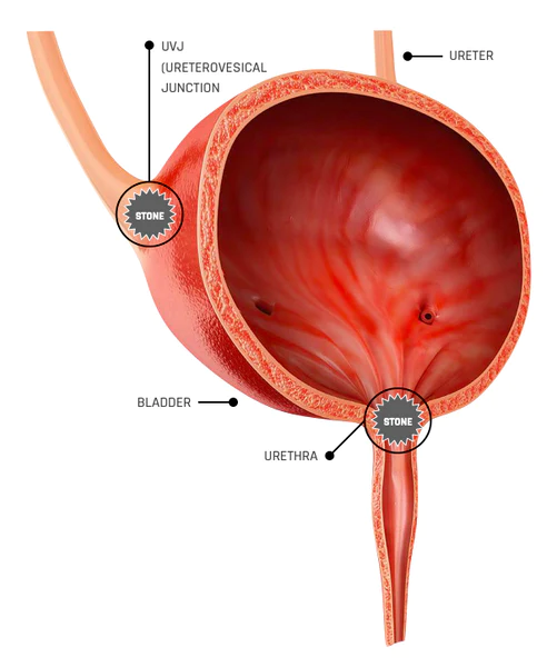 Illustration of where stones get stuck at the UVJ and the entrance to the urethra