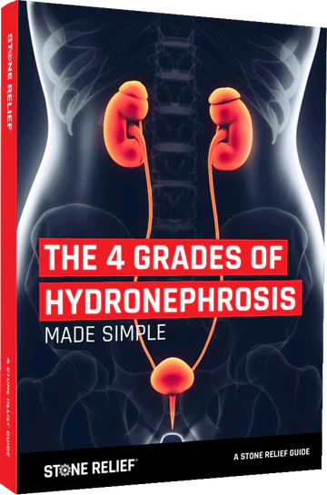 THE 4 GRADES OF HYDRONEPHROSIS MADE SIMPLE