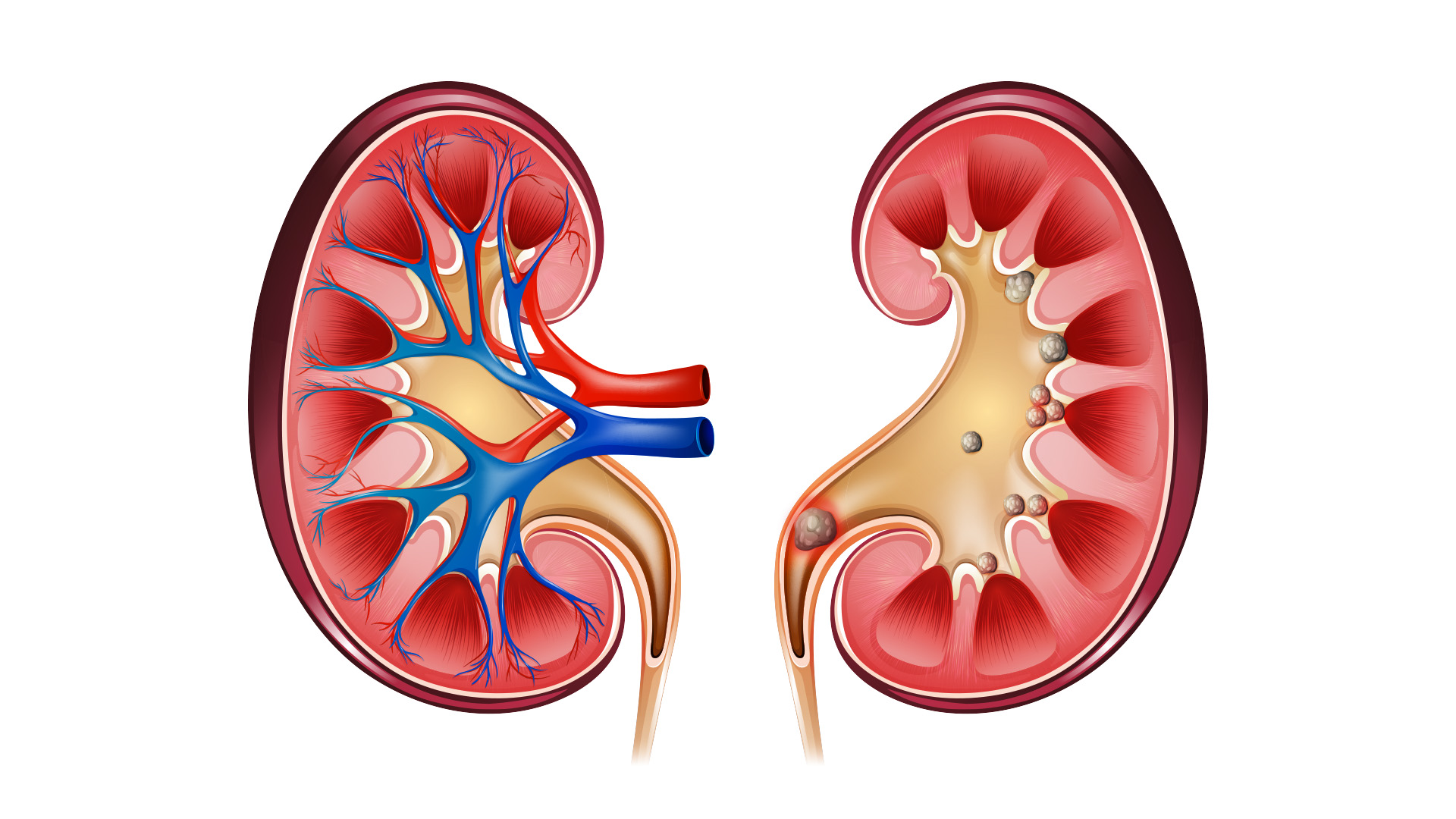 The Early Signs of Kidney Stones 