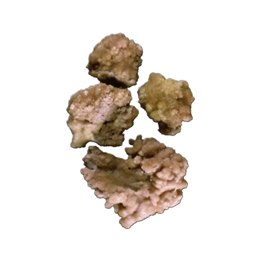 Calcium Oxalate Monohydrate Type 1e Stones