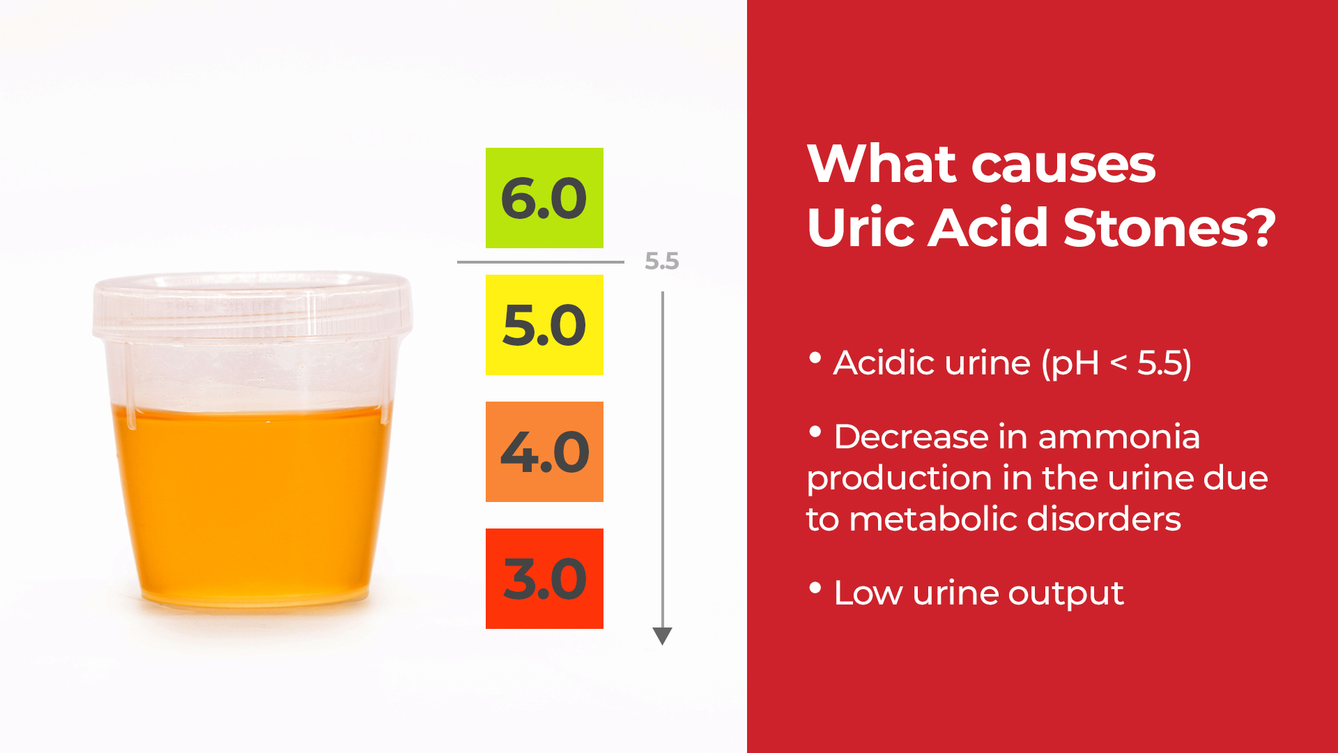 Factors that affect uric acid stone formation.