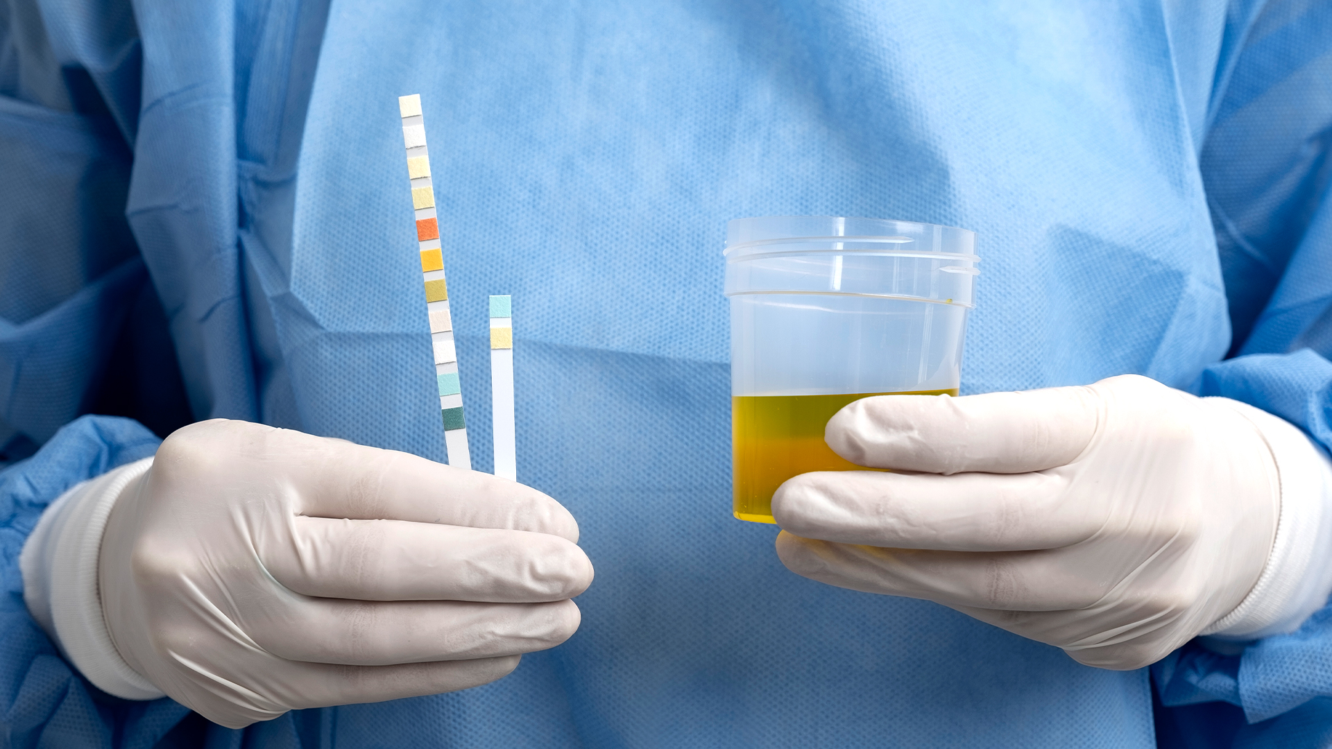 Urine pH Role in Kidney Stone Formation