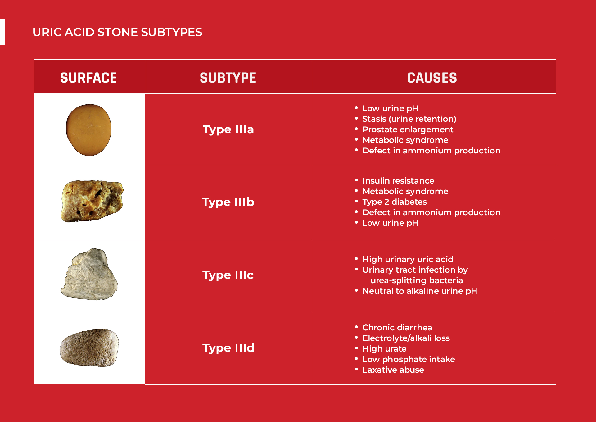Uric Acid Kidney Stone Subtypes