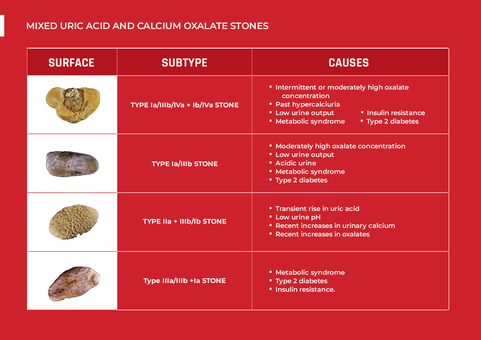 Mixed Uric Acid and Calcium Oxalate Subtypes