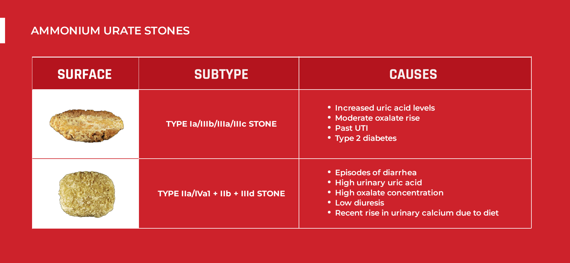 Ammonium Urate Stone Subtypes