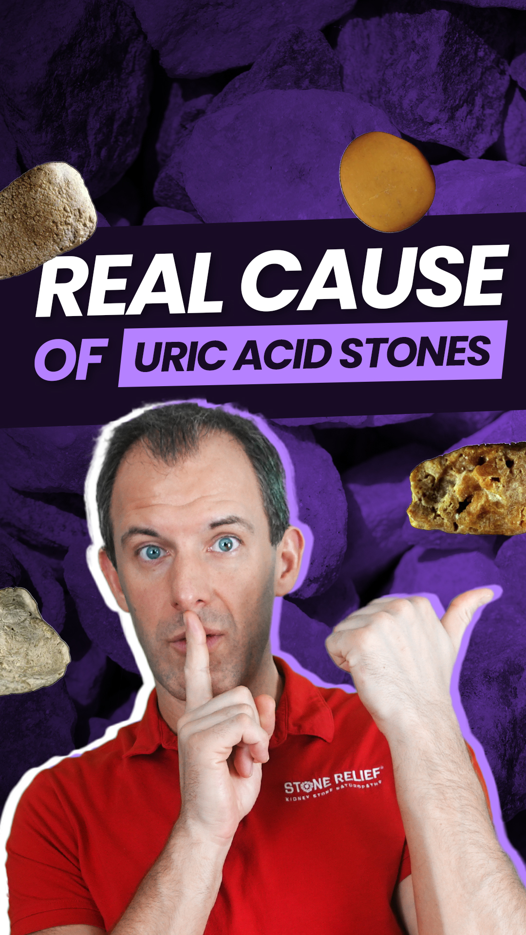 The REAL Cause of Uric Acid stones!