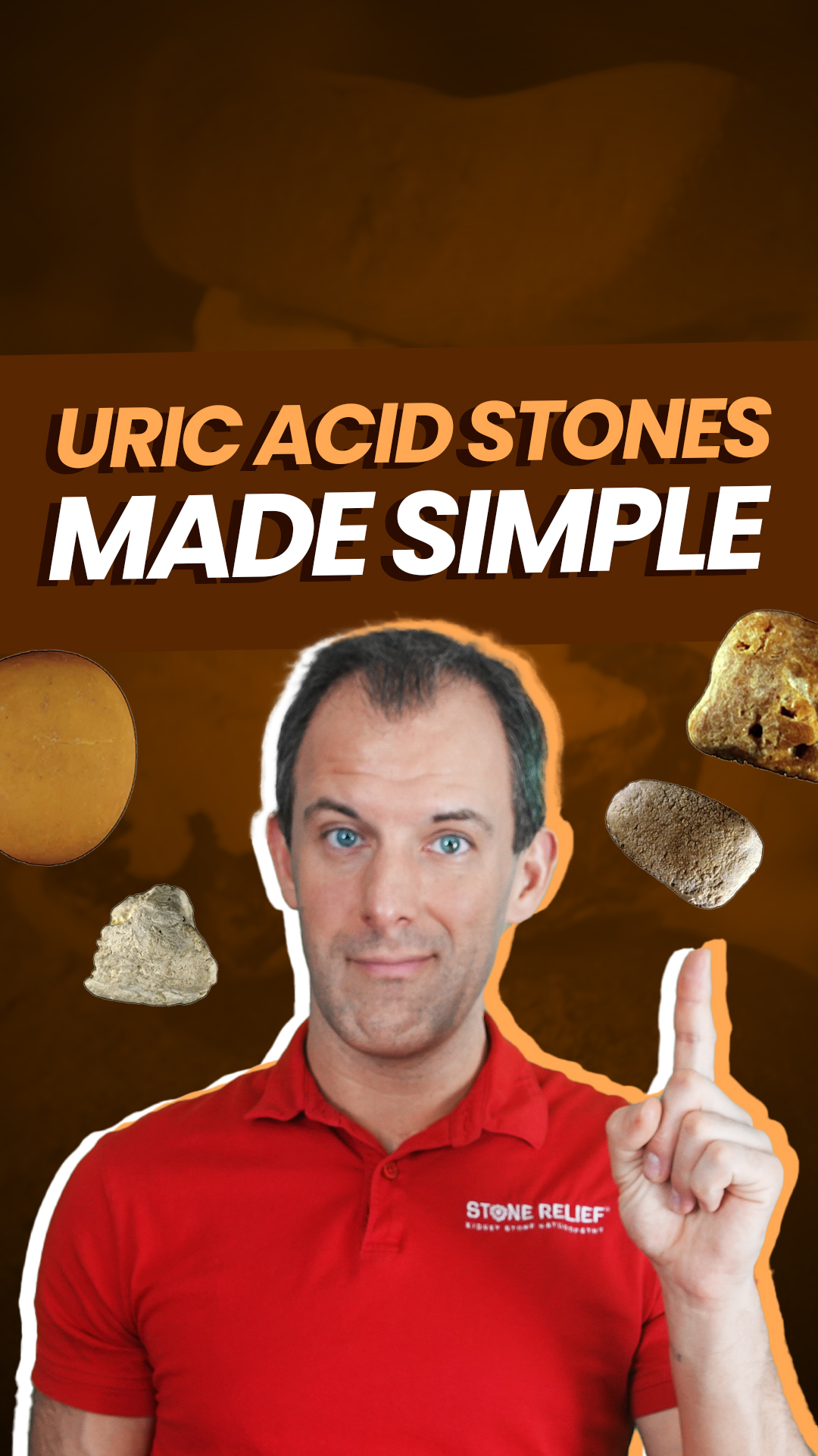 Uric acid stones made simple