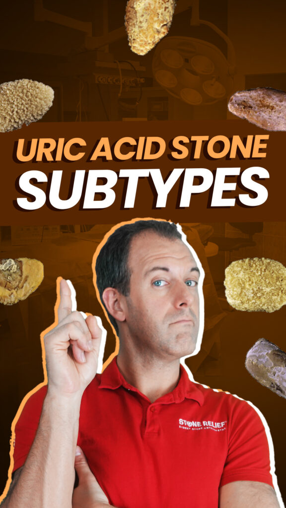 Meet the Uric Acid Stone Subtypes